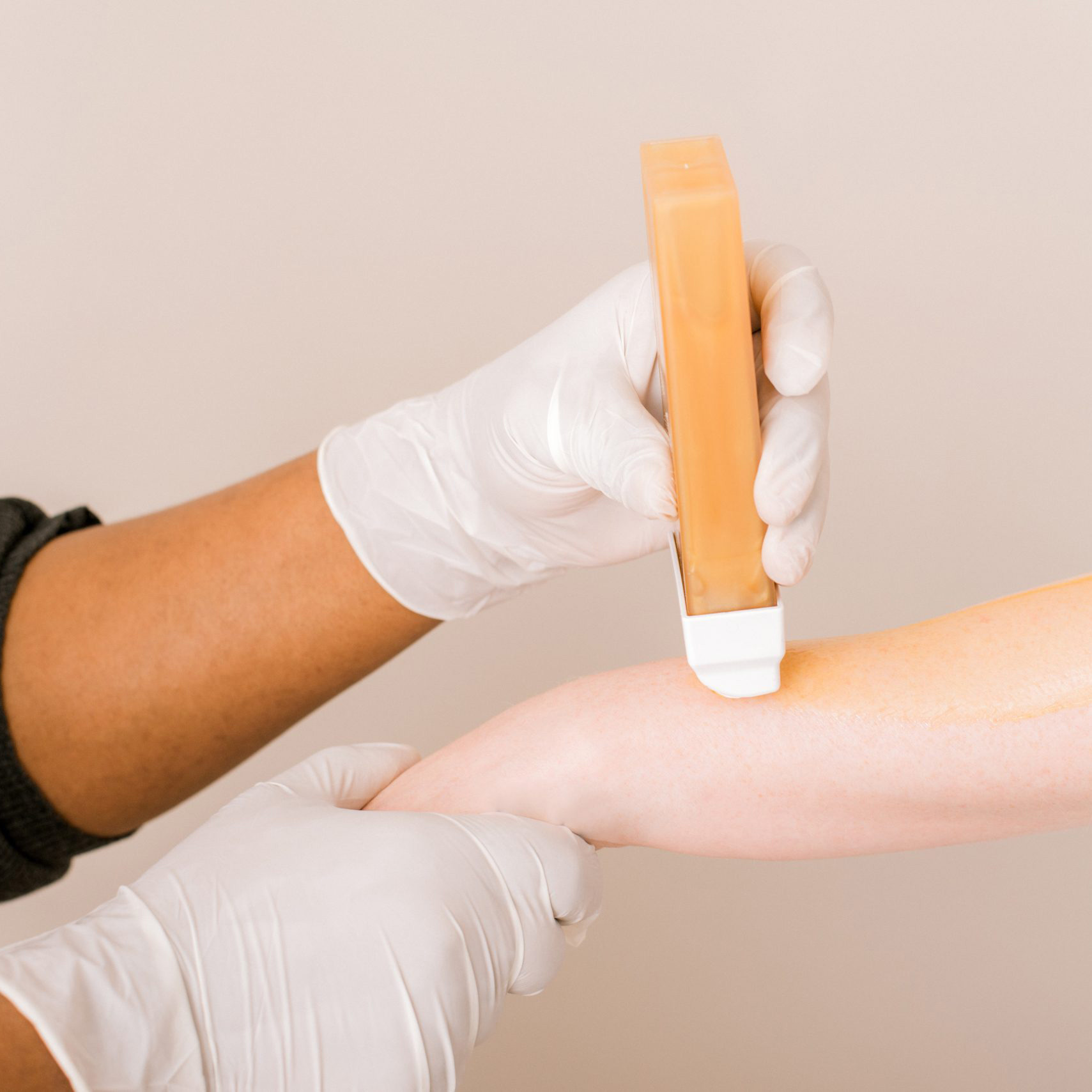 Gloved hand holding an orange handheld device against a patient’s forearm during a treatment.